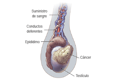 cancerTesticular