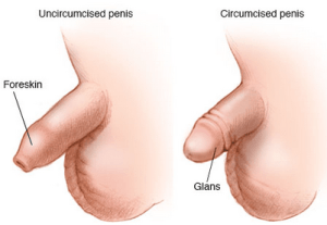 Circunsicion antes y despues
