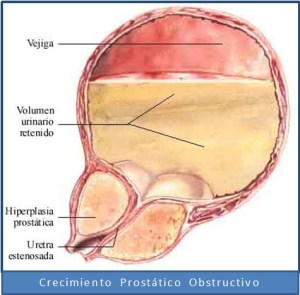 Crecimiento_prostatico_obstructivo1