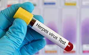 herpestesting.jpg
