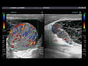 Orquiepididmitis aguda usg