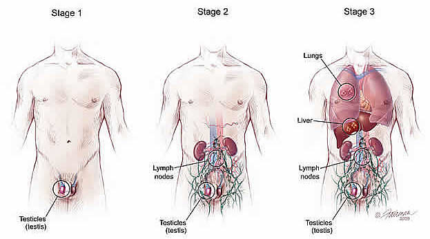 p-testicular_cancer2