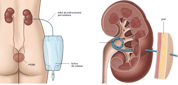 percutaneous-nephrostomy